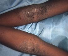 Image result for Eczema On Black Skin with Grey Colour