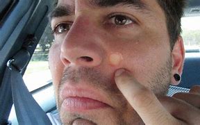 Image result for Big Pimple in the Face