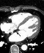 Image result for Interatrial Septum Lipomatous Hypertrophy Echo