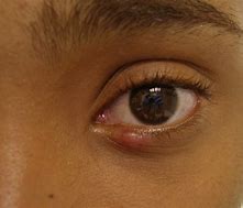 Image result for Stye Symptoms