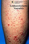 Image result for Vasculitis Leg Ulcers