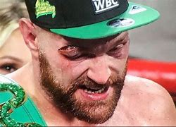 Image result for Tyson Fury Eye Injury