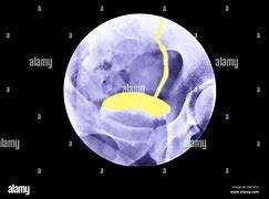 Image result for Kidney On X-ray