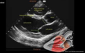 Image result for Parasternal View Cardiac Ultrasounds