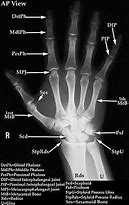 Image result for Normal Hand Radiograph