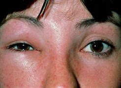 Image result for Bee Sting On a Human Eye