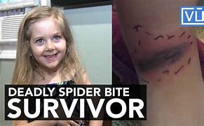 Image result for Widow Spider Bites Blue