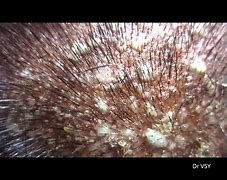 Image result for Hives with Pustules