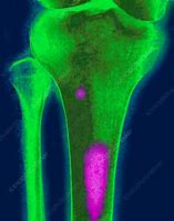 Image result for DDR and Bone Metastasis