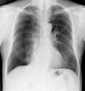 Image result for Signs of Collapsed Lung