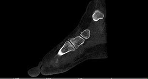 Image result for Lisfranc Orif