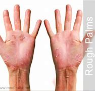 Image result for Palms Rough and Cracked