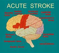 Image result for Acute Stroke