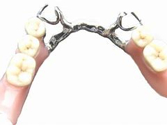 Image result for Partial Denture Clasps