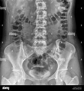 Image result for Kidney On X-ray