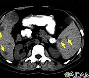 Image result for Spleen Metastasis