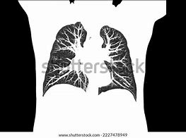 Image result for Coronal Lung CT