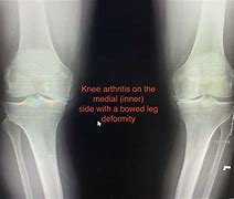 Image result for Patellofemoral Joint Space Narrowing