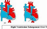 Image result for Right Ventricular Hypertrophy