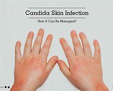 Image result for Candida Skin Rash Symptoms