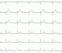 Image result for Pericarditis EKG Findings Example