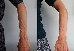 Image result for Veins On Forearm