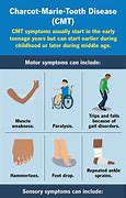 Image result for Charcot Bone Disease