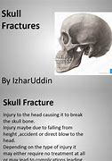 Image result for Skull Fracture