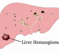 Image result for Hemangioma On Liver