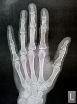 Image result for Normal Hand Radiograph