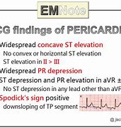 Image result for Pericarditis EKG Findings Example