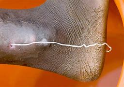 Image result for Parasitic Worms