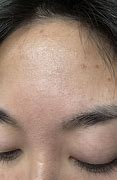 Image result for Pustules On Forehead