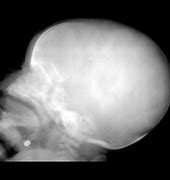 Image result for Achondroplasia X-ray