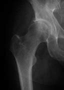 Image result for Hip Joint Space Narrowing