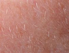 Image result for Mites On Face Skin Infection