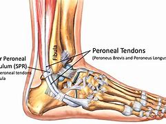 Image result for Peroneal Tendinopathy