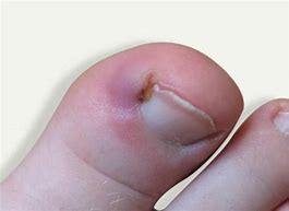 Image result for Pedicure for Ingrown Toenail