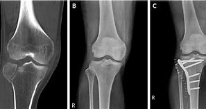 Image result for CT Knee Radiopaedia