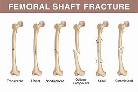 Image result for Orif Hip