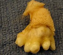 Image result for teratoma symptoms