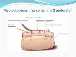 Image result for Anterolateral Thigh Flap