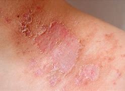 Image result for MSAD Skin