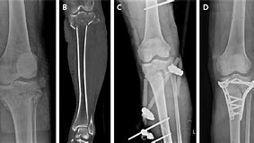 Image result for CT Knee Radiopaedia