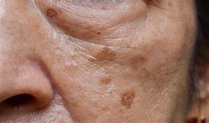 Image result for Dark Red Spots On Skin