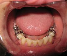 Image result for Partial Denture Clasps