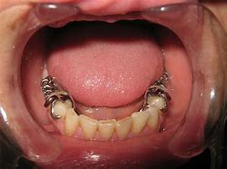 Image result for partial denture clasps materials