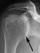 Image result for Arthritc Shoulder