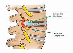 Image result for Lumbar Spine Herniation