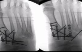 Image result for Lisfranc Orif